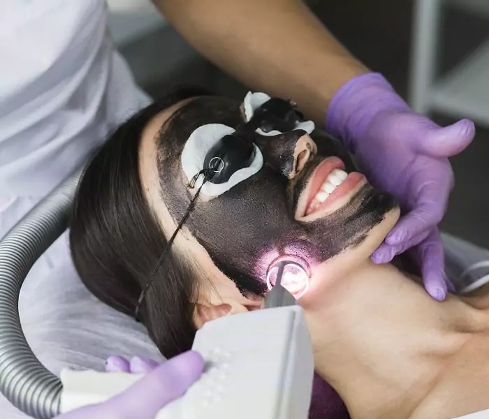 Black Laser Carbon Facial